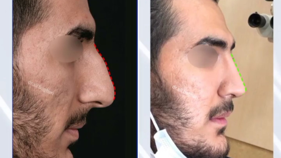 جراحی بینی با پوست ضخیم دکتر علی باقری حق