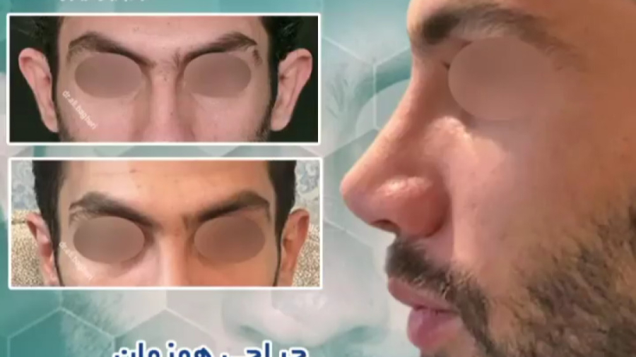 جراحی همزمان اتوپلاستی و رینوپلاستی دکتر علی باقری حق