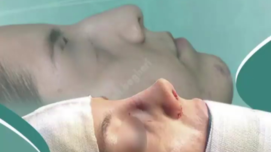 بلافاصله بعد از جراحی زیبایی بینی دکتر علی باقری حق