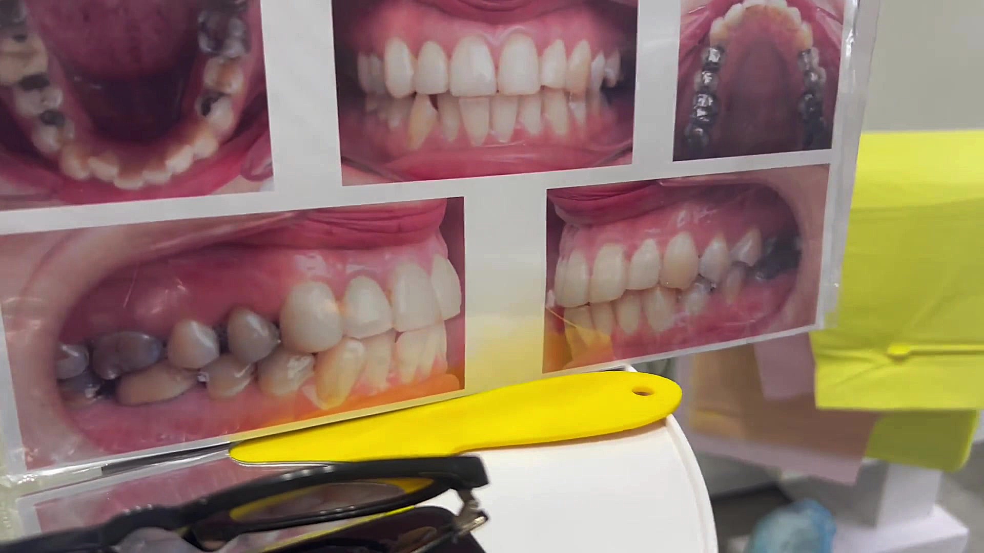 جلسه اول ارتودنسی خیلی راحته دكتر مهدي فهيمي هنزائي