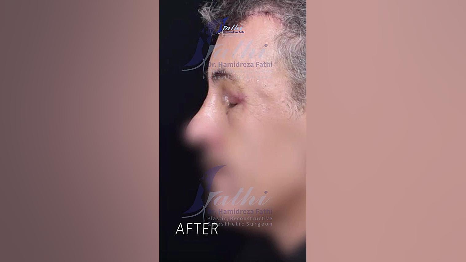 بلفاروپلاستی و لیفت پیشانی برای مراجعه کننده ی عزیزمون دکتر حمید رضا فتحی فوق تخصص جراحی پلاستیک