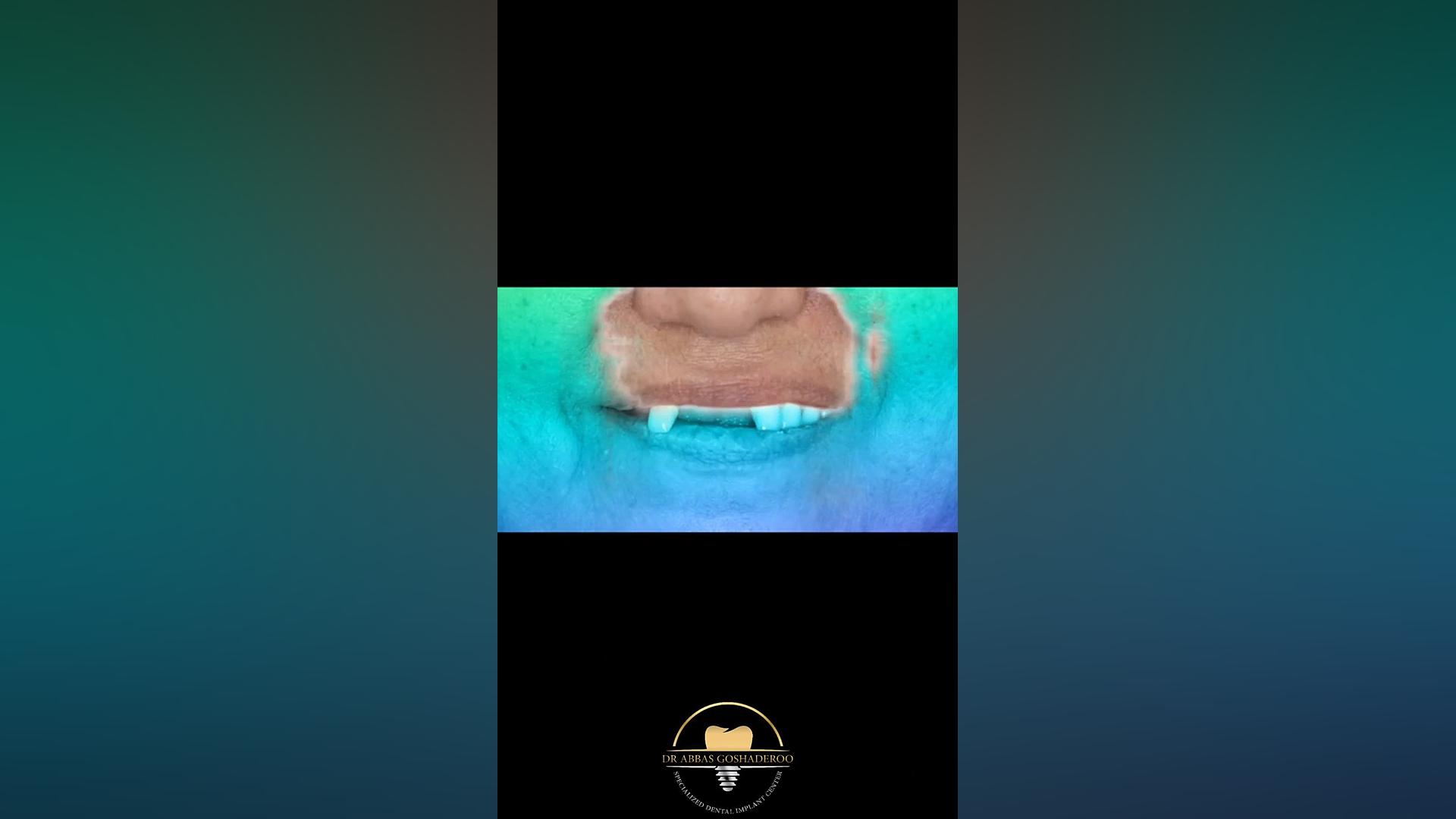 تغییر عالی با ایمپلنت دکتر عباس گشاده رو، متخصص جراحی لثه و ایمپلنت