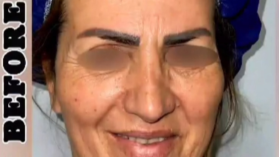جراحی لیفت صورت دکتر رفیع پرنیا فوق تخصص پلاستیک