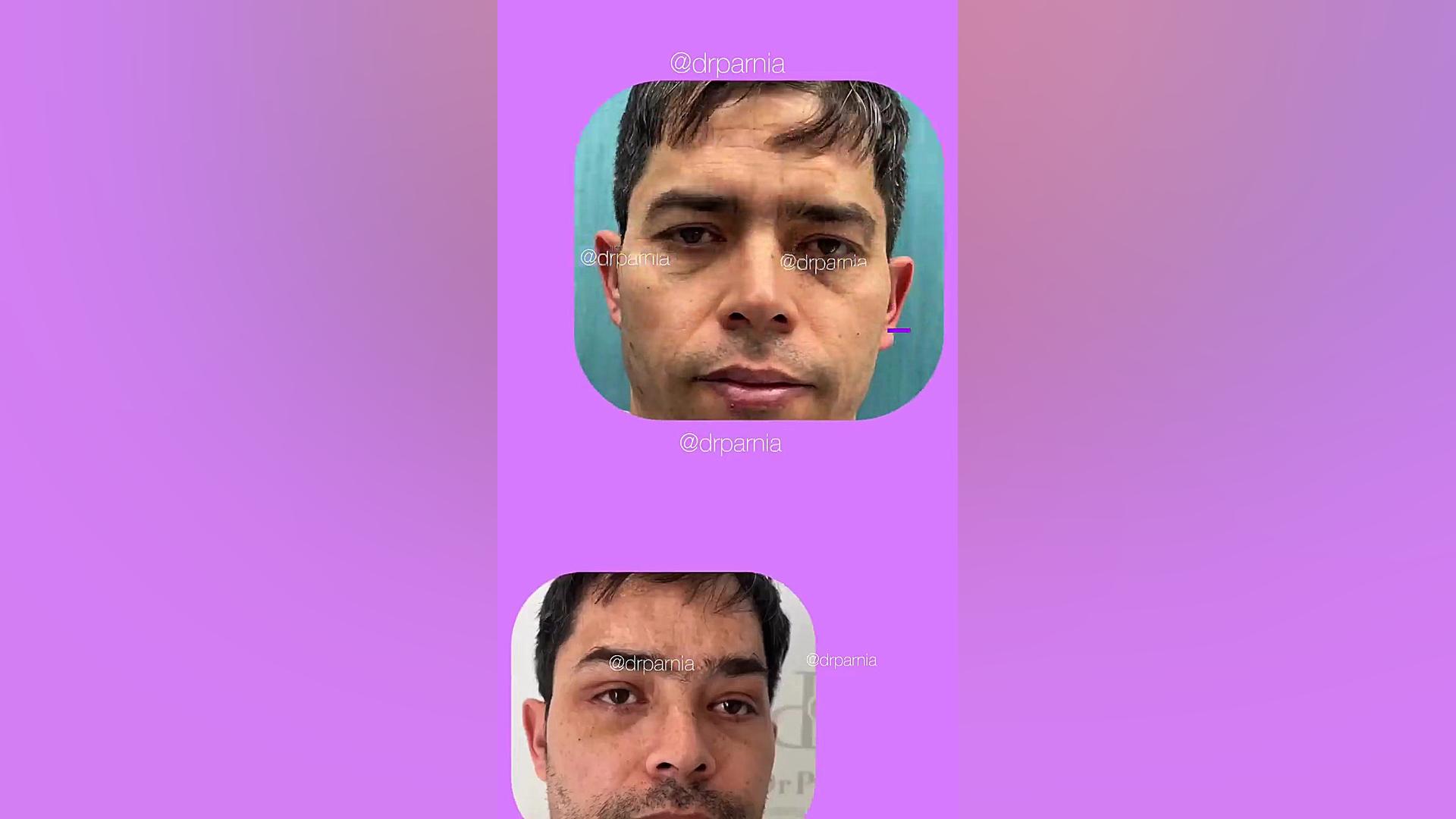 نتیجه تزریق بوتاکس پیشانی دکتر رفیع پرنیا فوق تخصص پلاستیک