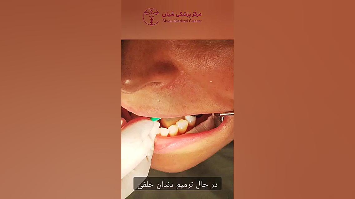 ترمیم دندان خلفی In Situ Hybridization