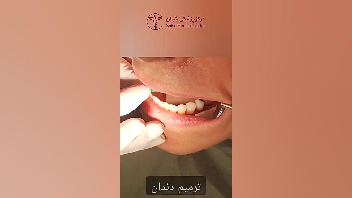 ترمیم دندان بلیچینگ