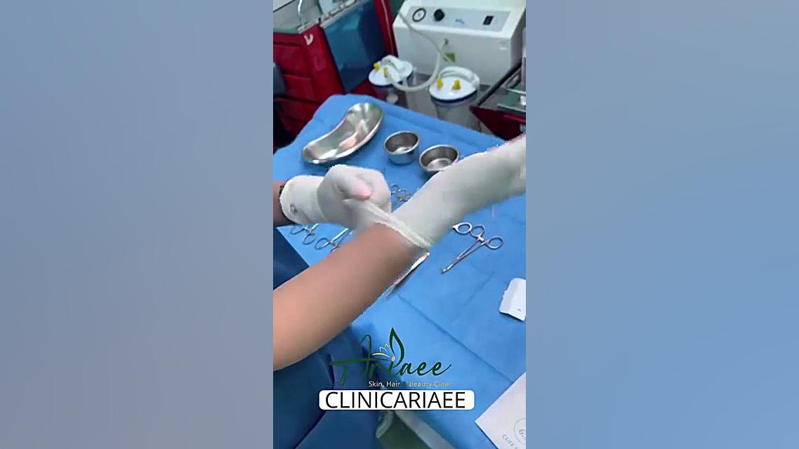 فیلم کاشت ابرو طبیعی بیماری گلوکوزامینوگلیکان تجمعی