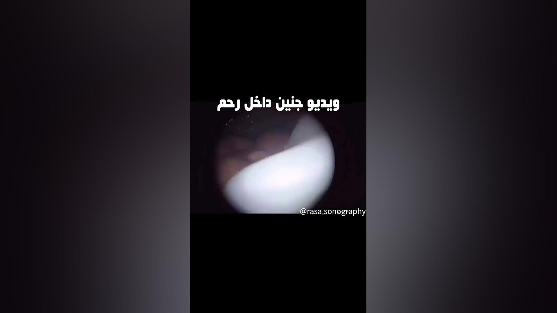مشخص شدن شکل جنین داخل شکم مادر ویدیو