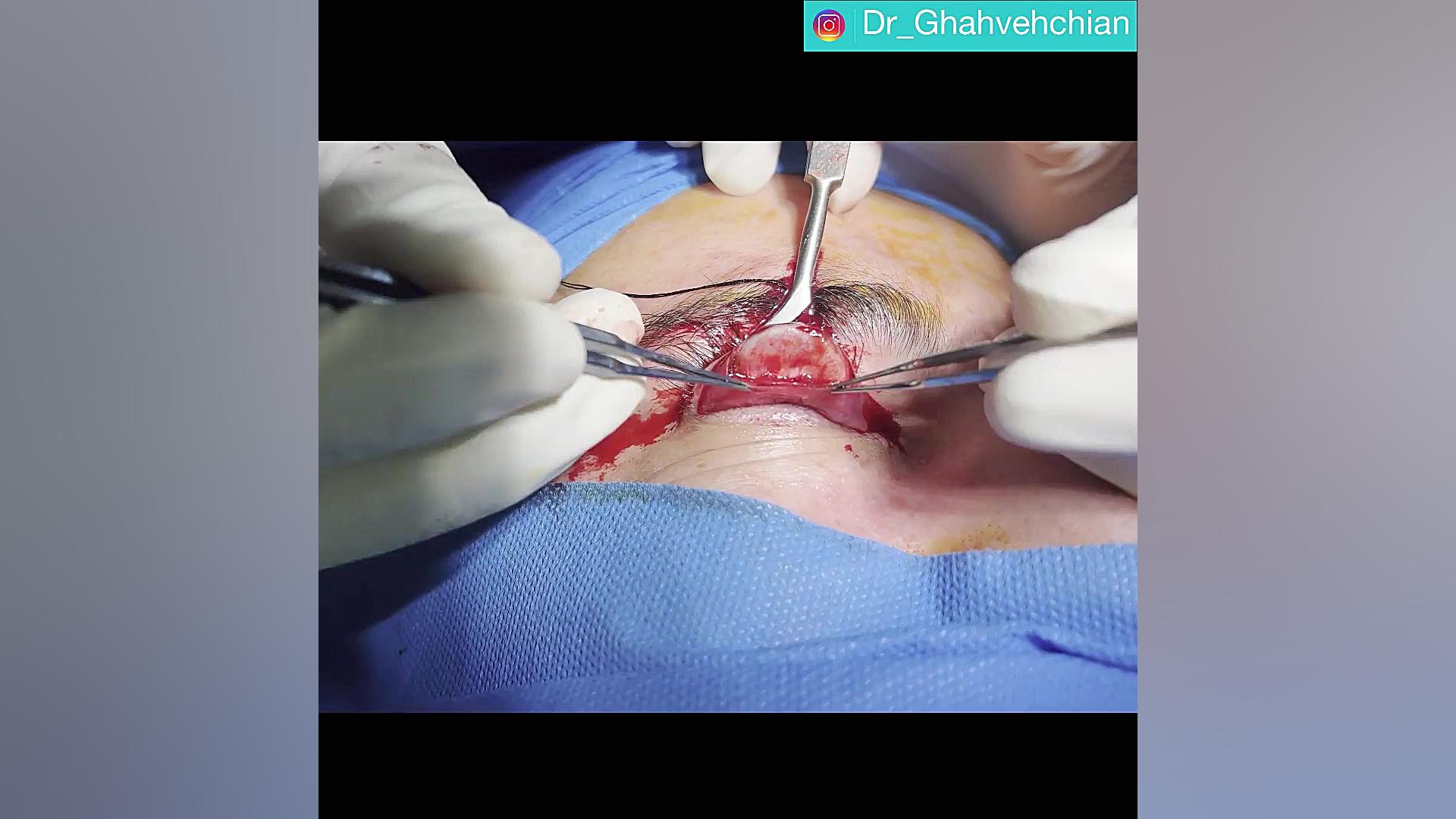 اصلاح افتادگی پلک (پتوز) در سندرم هورنر بدون برش پوستی هموکروماتوز