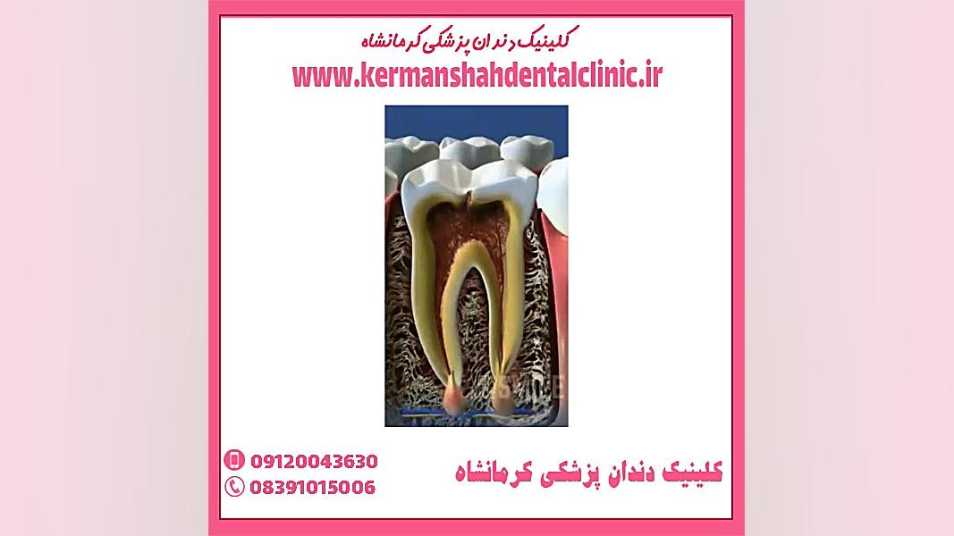 عصب کشی دندان آزمون فعالیت آنزیم G6PD