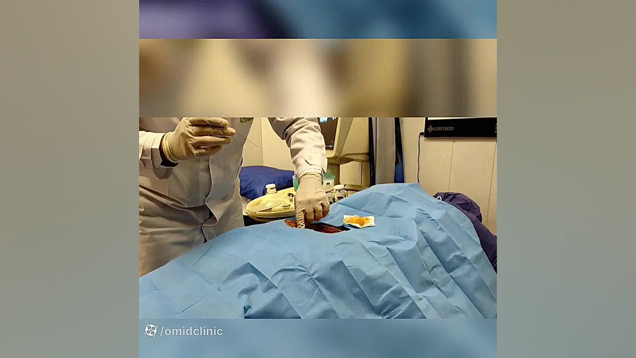 مراحل تزریق PRP توسط متخصص طب فیزیکی و توانبخشی منافذ باز پوست
