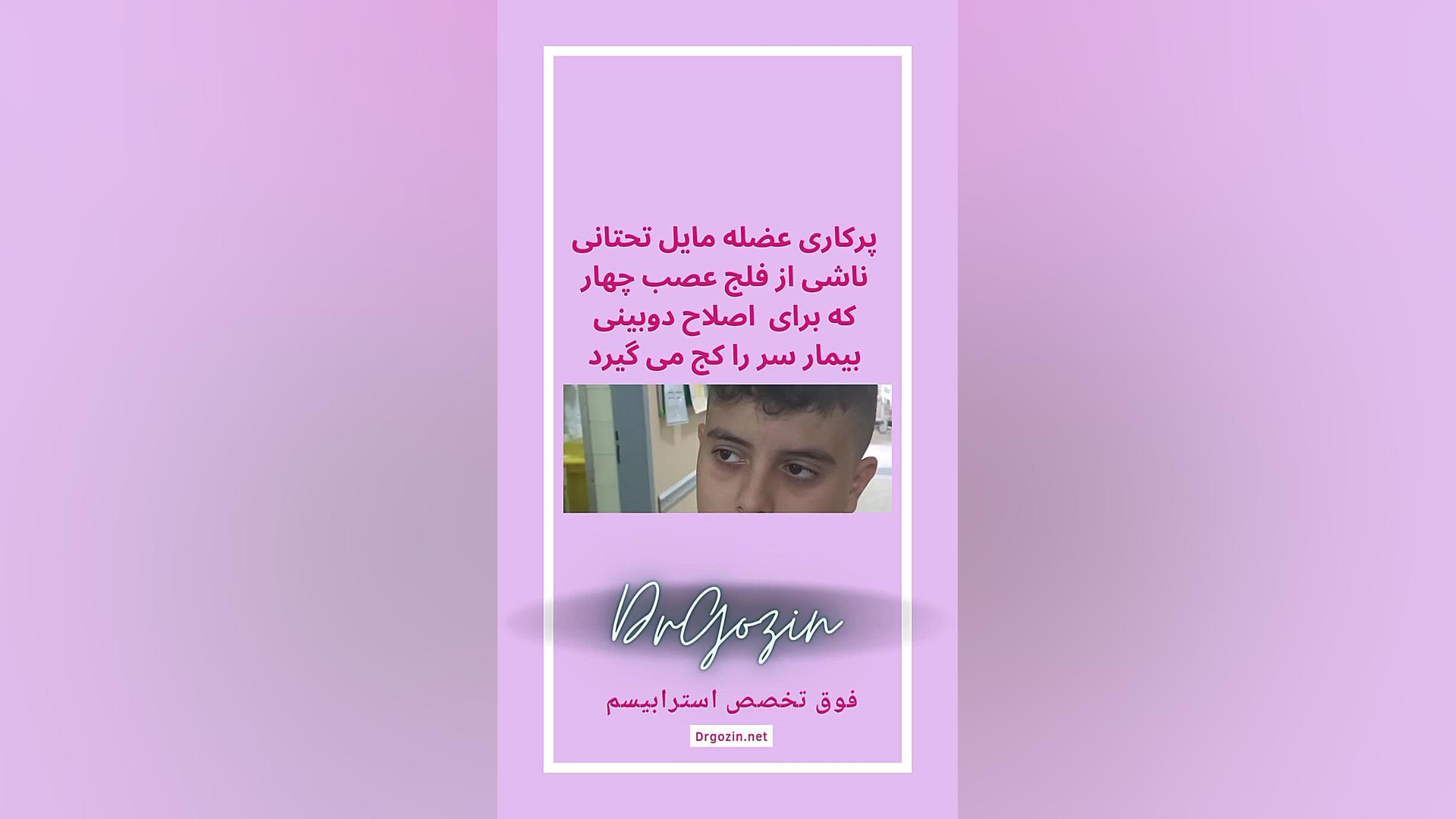 بهترین فوق تخصص انحراف چشم دکتر گزین، جراحی فلج عصب چهار ۴ اینسایزینگ