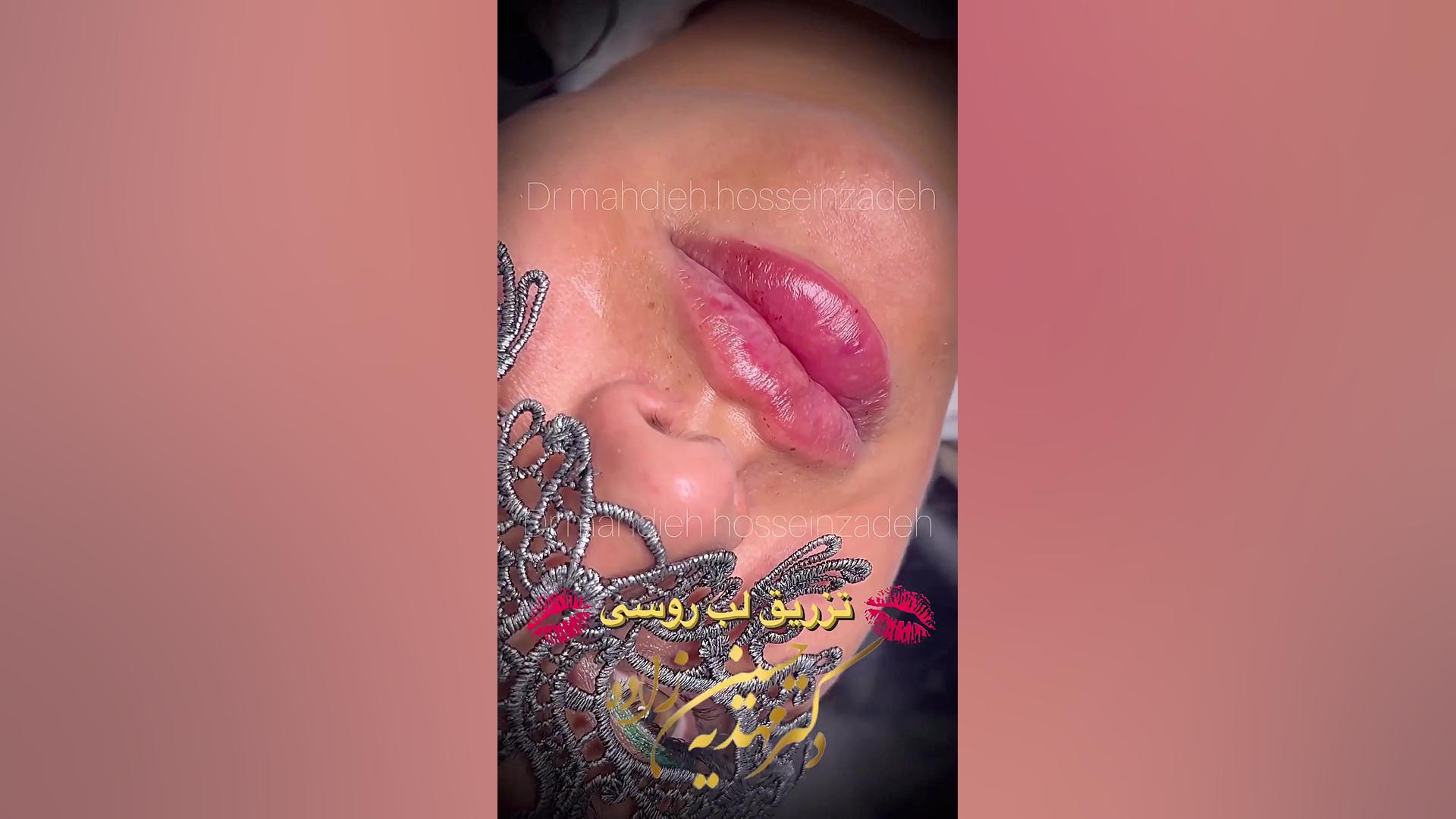 تزریق ژل لب روسی دکتر مهدیه حسین زاده تزریق ژلب لب روسی در رشت کلینیک زیبایی رشت دکتر مهدیه حسین زاده