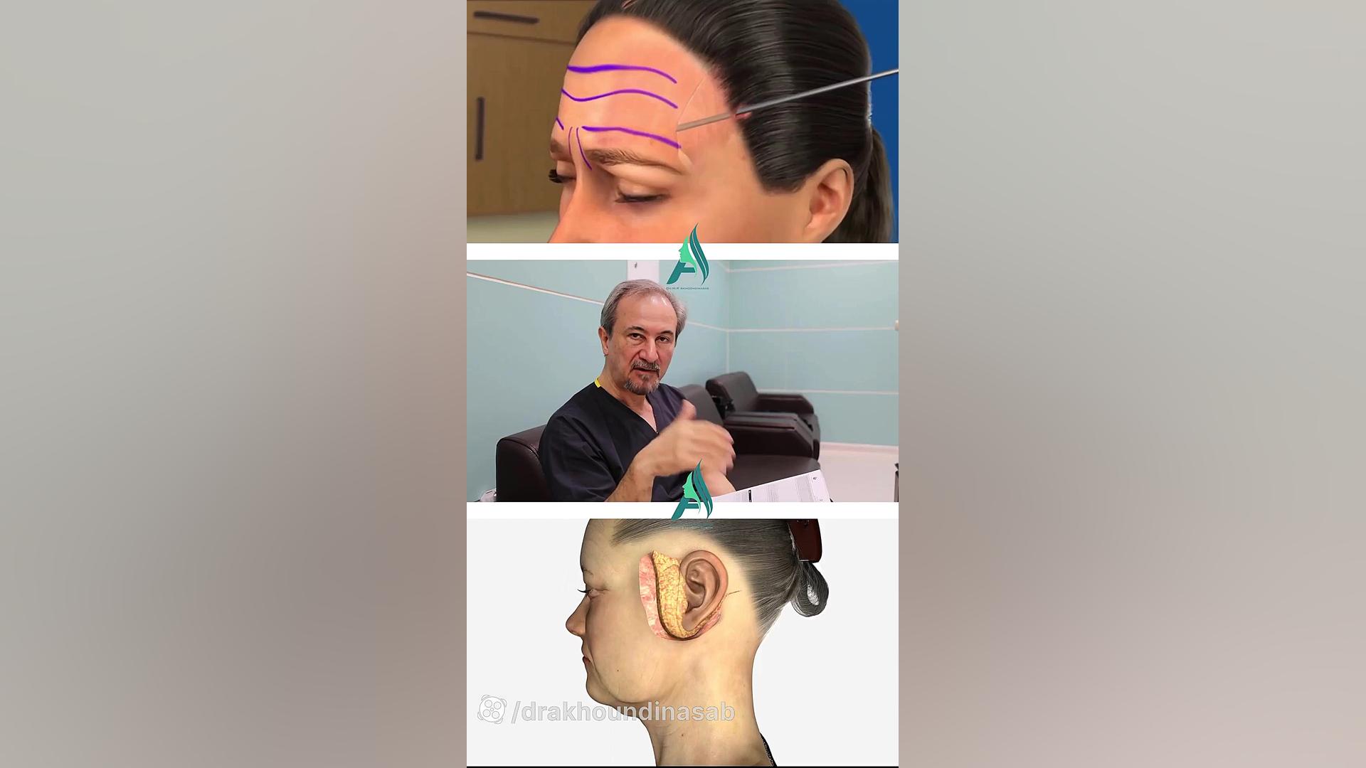 تفاوت لیفت پیشانی در خانم ها و آقایان دکتر محمدرضا آخوندی نسب-فوق تخصص جراحی پلاستیک