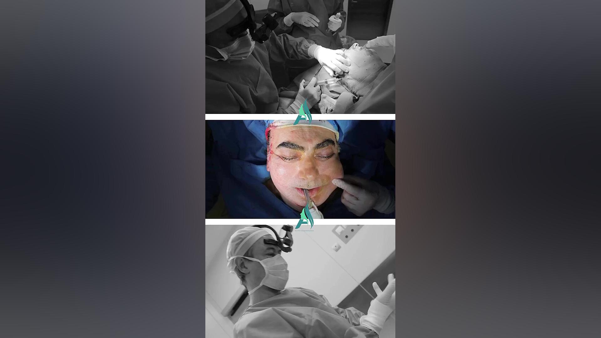 جراحی لیفت صورت و گردن دکتر محمدرضا آخوندی نسب-فوق تخصص جراحی پلاستیک