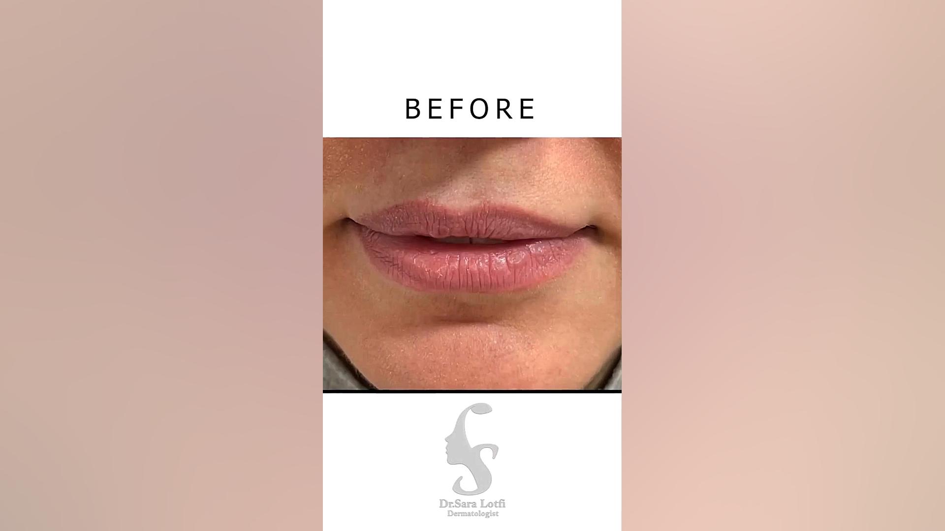 فیلر لب دکتر سار ا لطفی