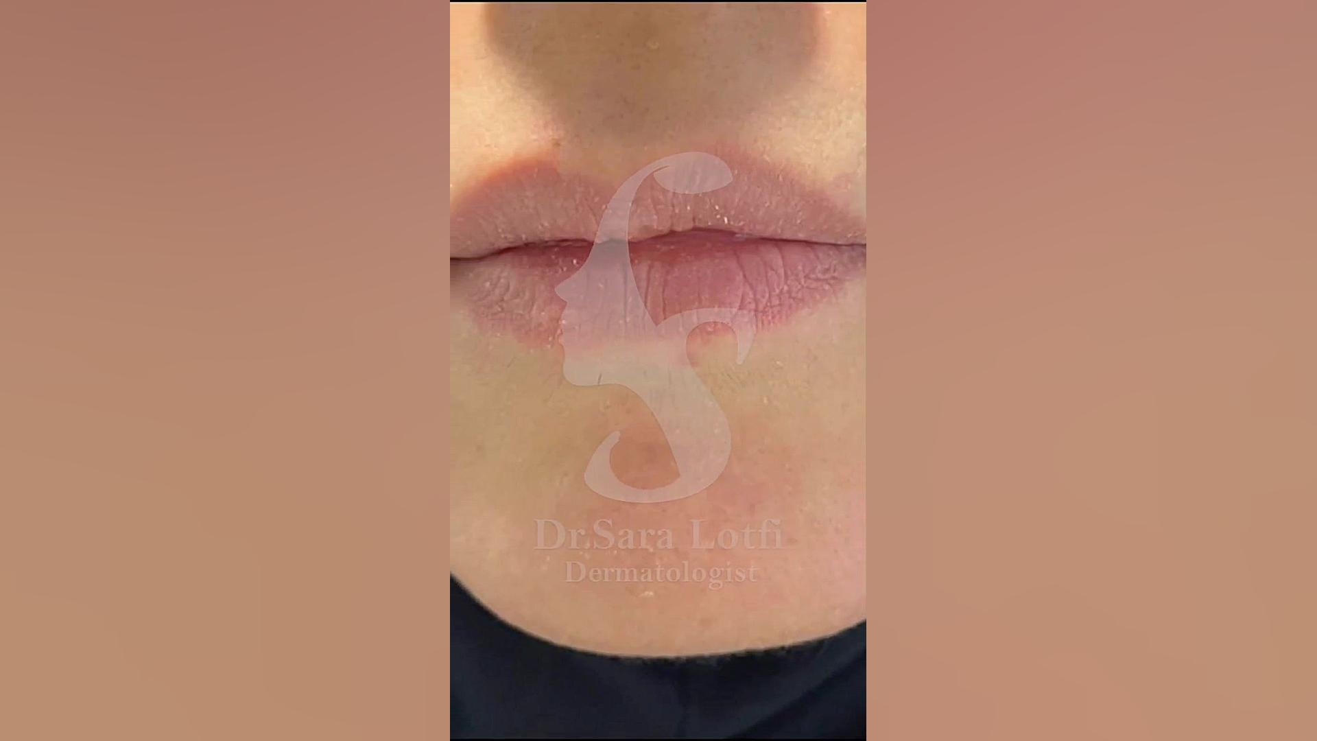 فیلر لب دکتر سار ا لطفی