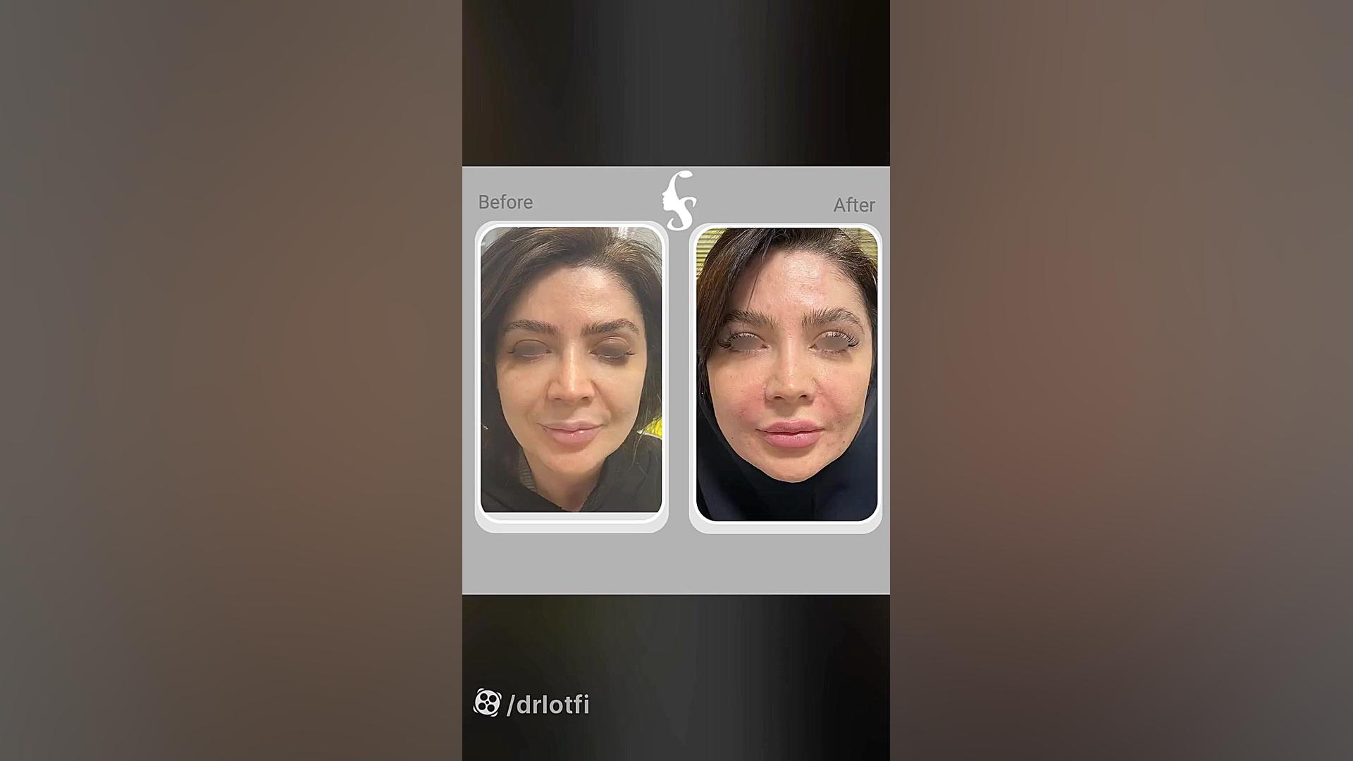 تزریق به لب، خط خنده و زاویه فک دکتر سار ا لطفی