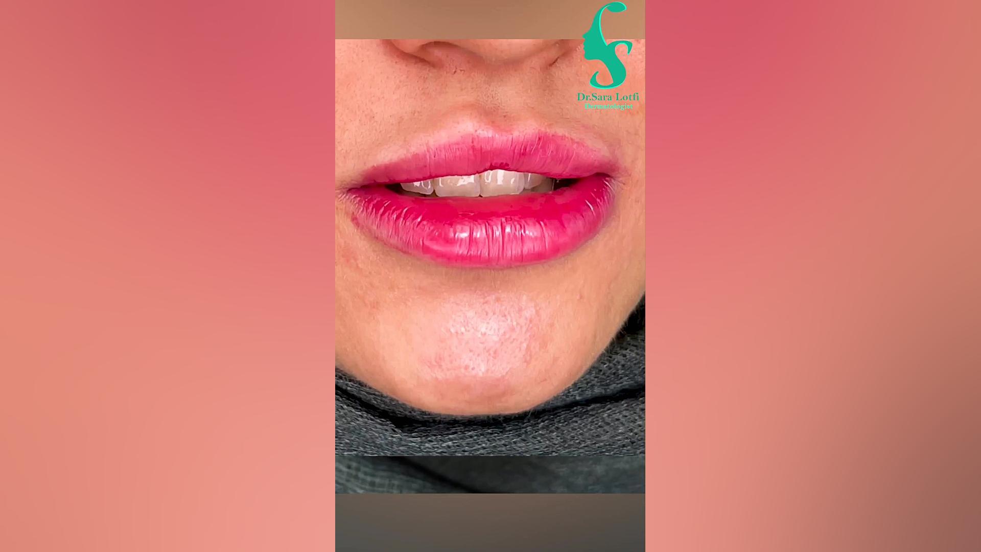 فیلر لب دکتر سار ا لطفی