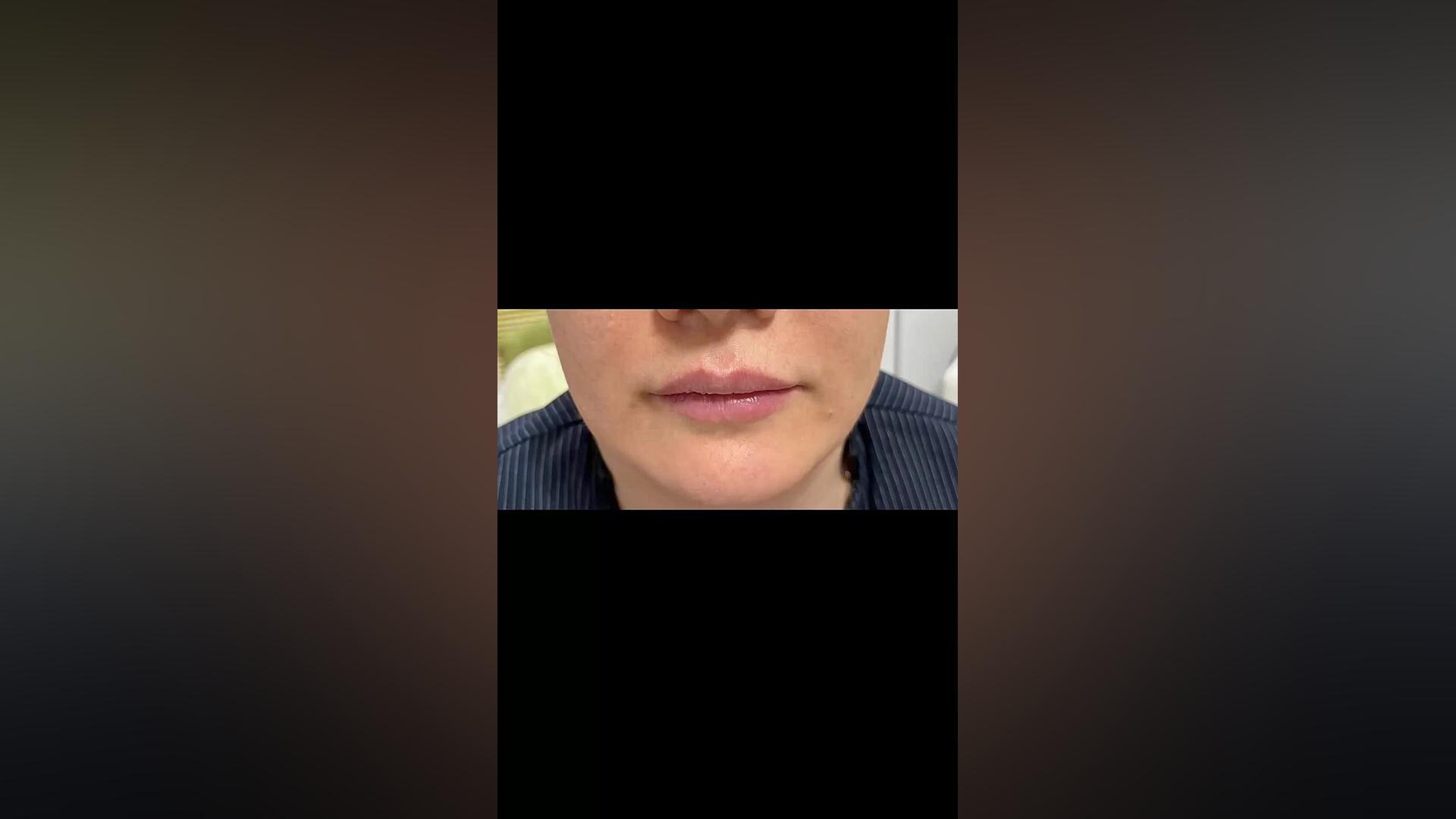 فیلر لب دکتر سار ا لطفی