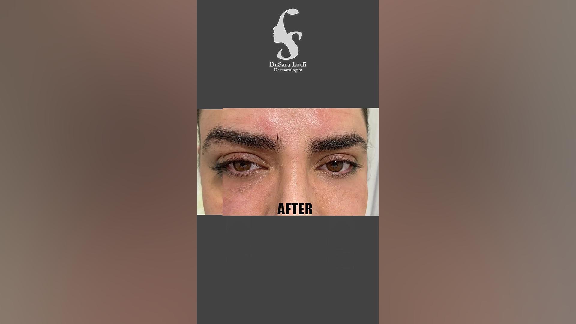 تزریق فیلر زیر چشم دکتر سار ا لطفی
