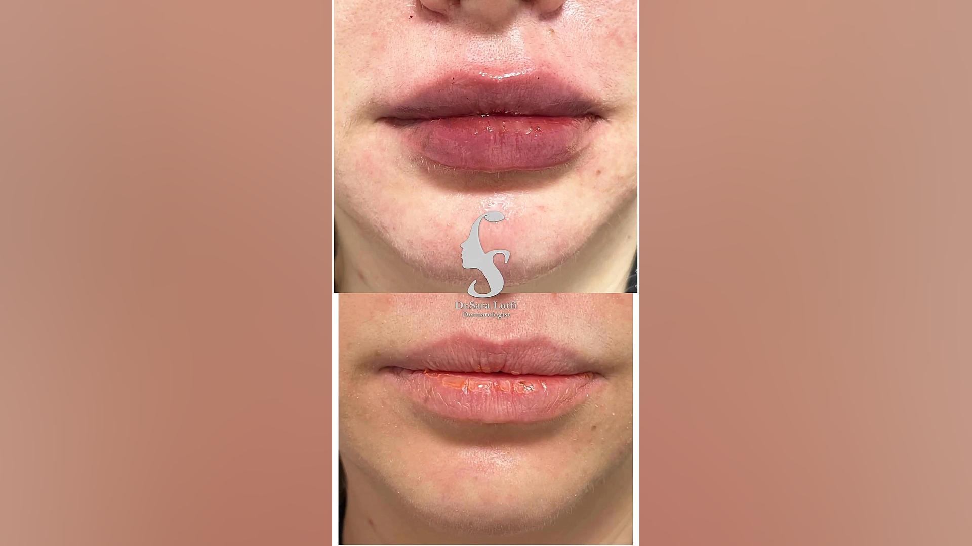 تزریق فیلر لب دکتر سار ا لطفی