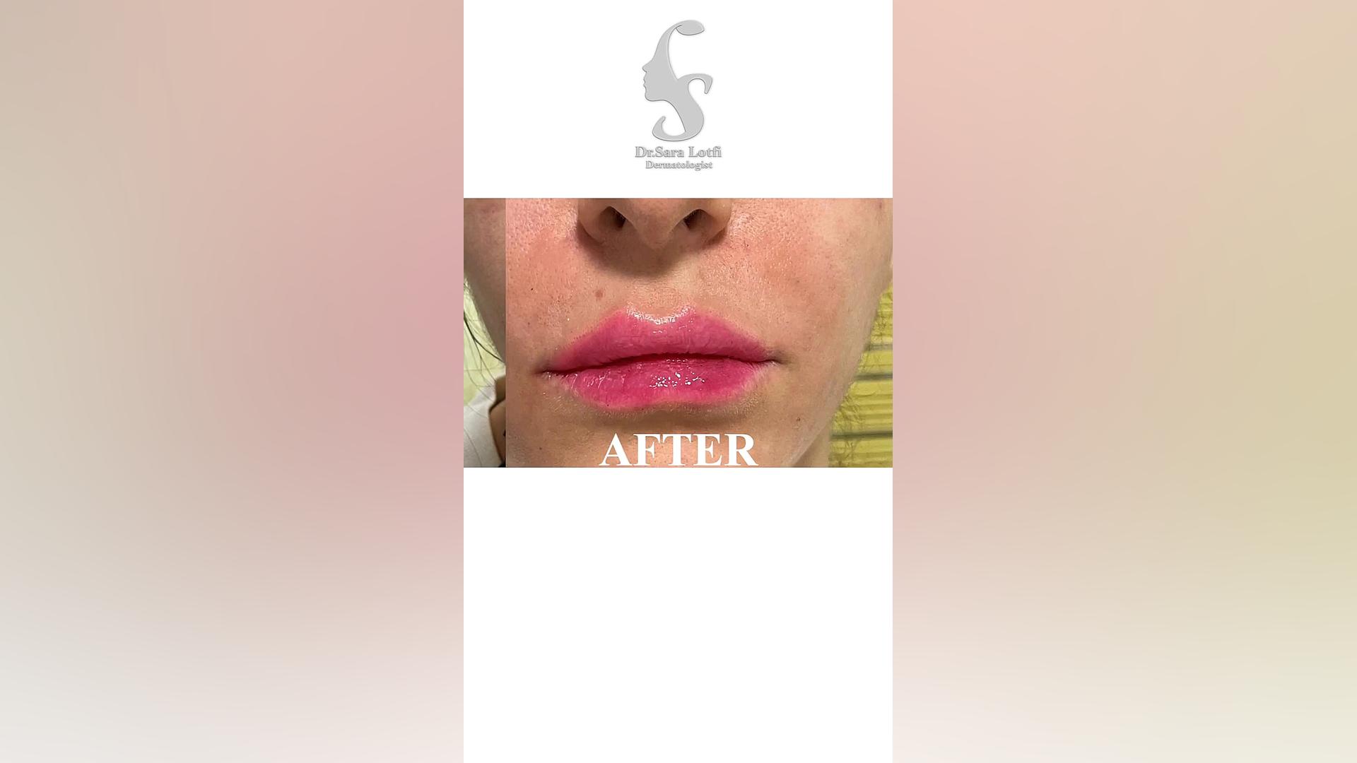 فیلر لب دکتر سار ا لطفی