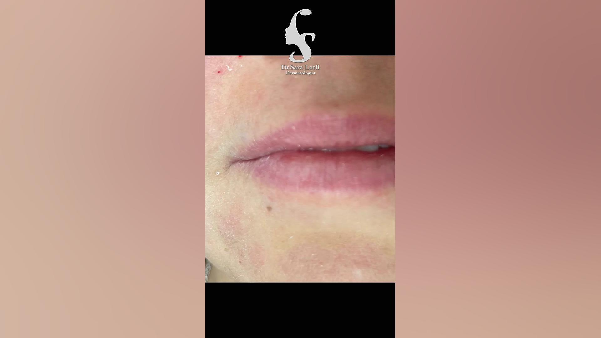 فیلر لب دکتر سار ا لطفی