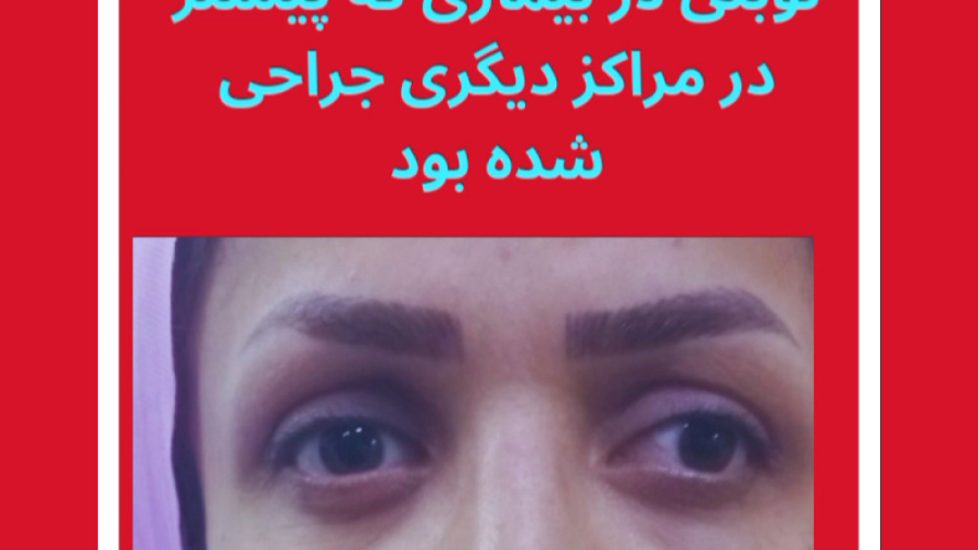 جراحی انحراف چشم بدون بیهوشی، دکتر گزین فوق تخصص انحراف چشم و استاد دانشگاه دندانپزشک زیبایی