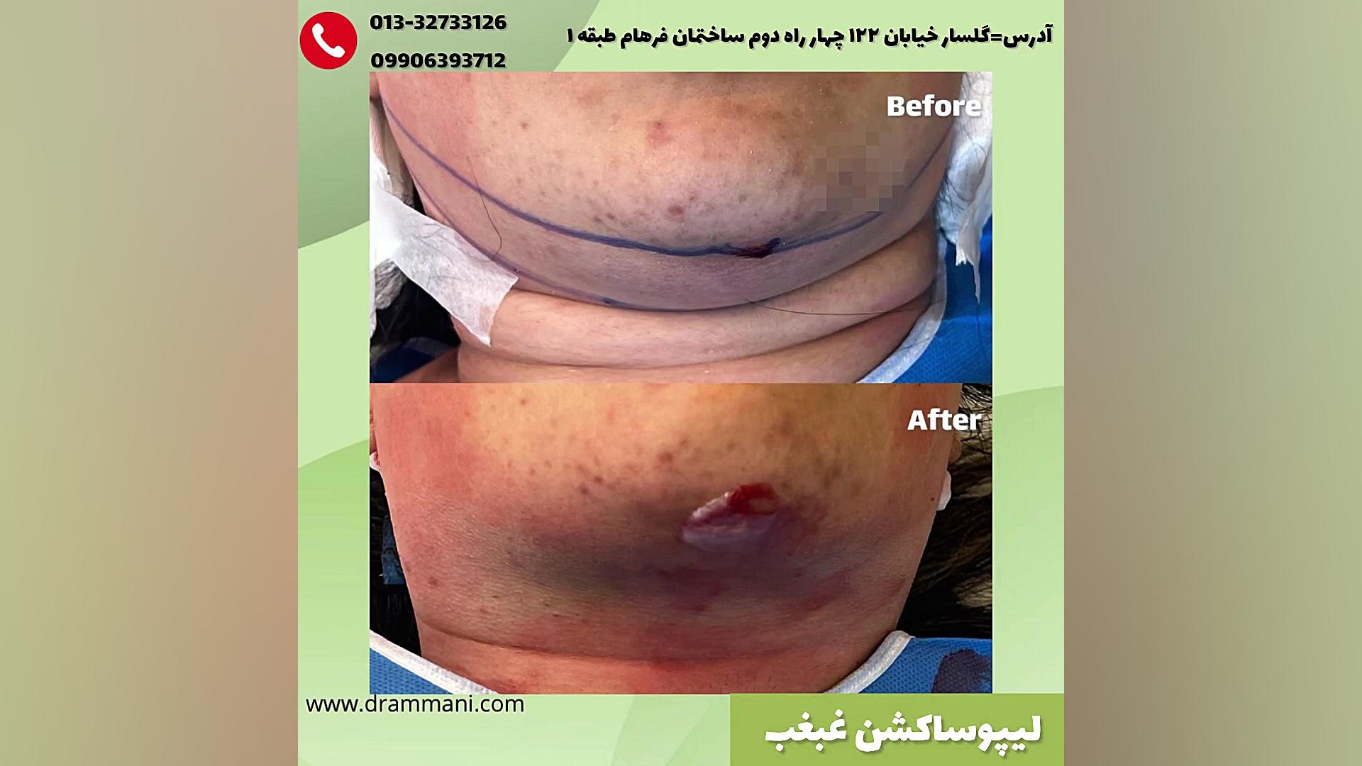 لیپوساکشن غبغب در رشت هپاتواسپلنومگالی