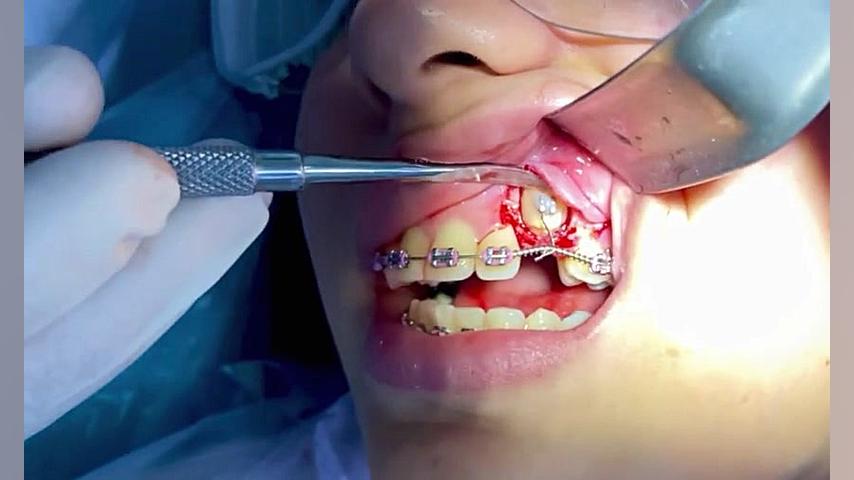 دندان نهفته و ارتودنسی دكتر مهدي فهيمي هنزائي