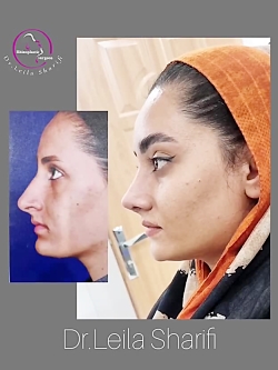 عمل بینی دخترانه - دکتر لیلا شریفی