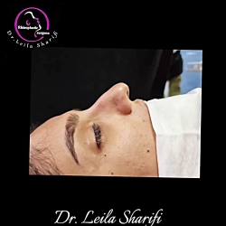 ویدئو قبل و بعد عمل بینی - دکتر لیلا شریفی