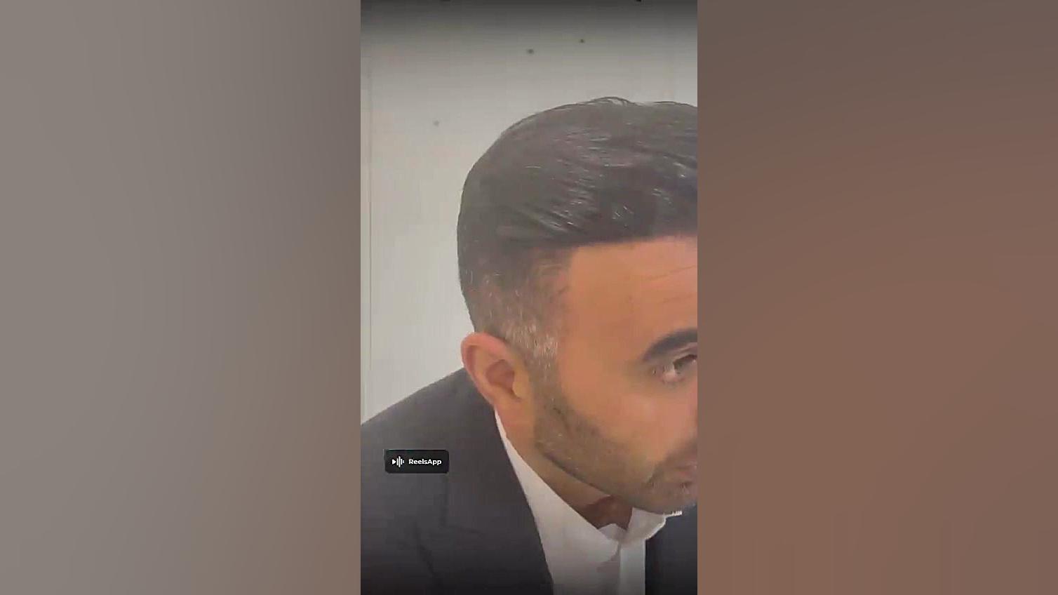 کلینیک کاشت مو دکتر علیزاده بیماری استئوجنز ایمپرفکتا