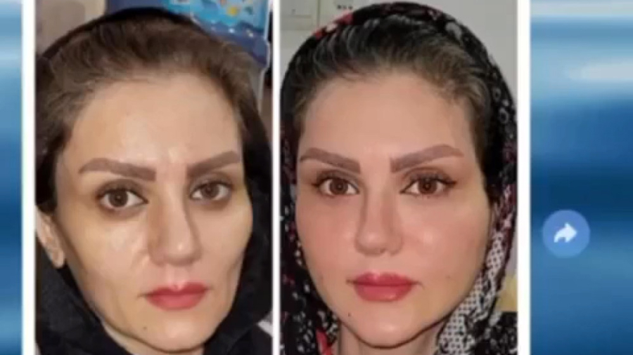 قبل و بعد از تزریق چربی به صورت | دکتر کفایی ربات میکرونانو جراحی