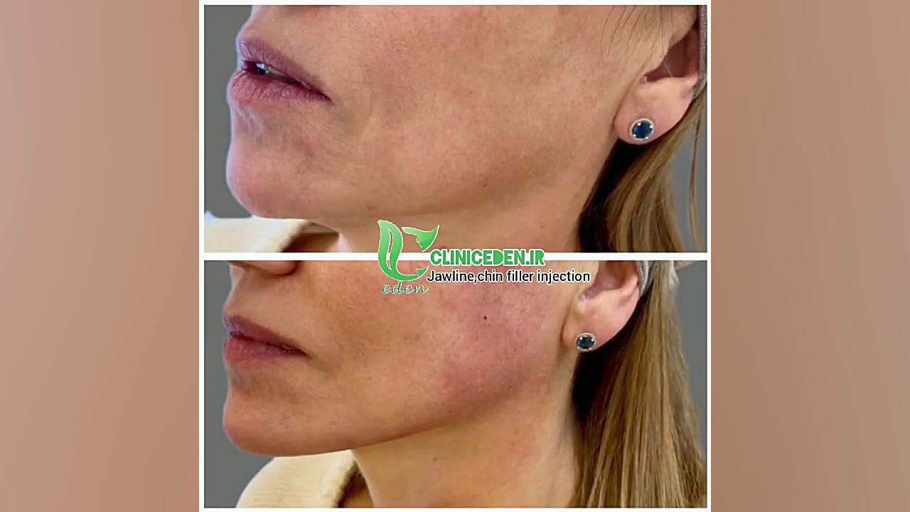 زاویه سازی صورت لیپوساکشن