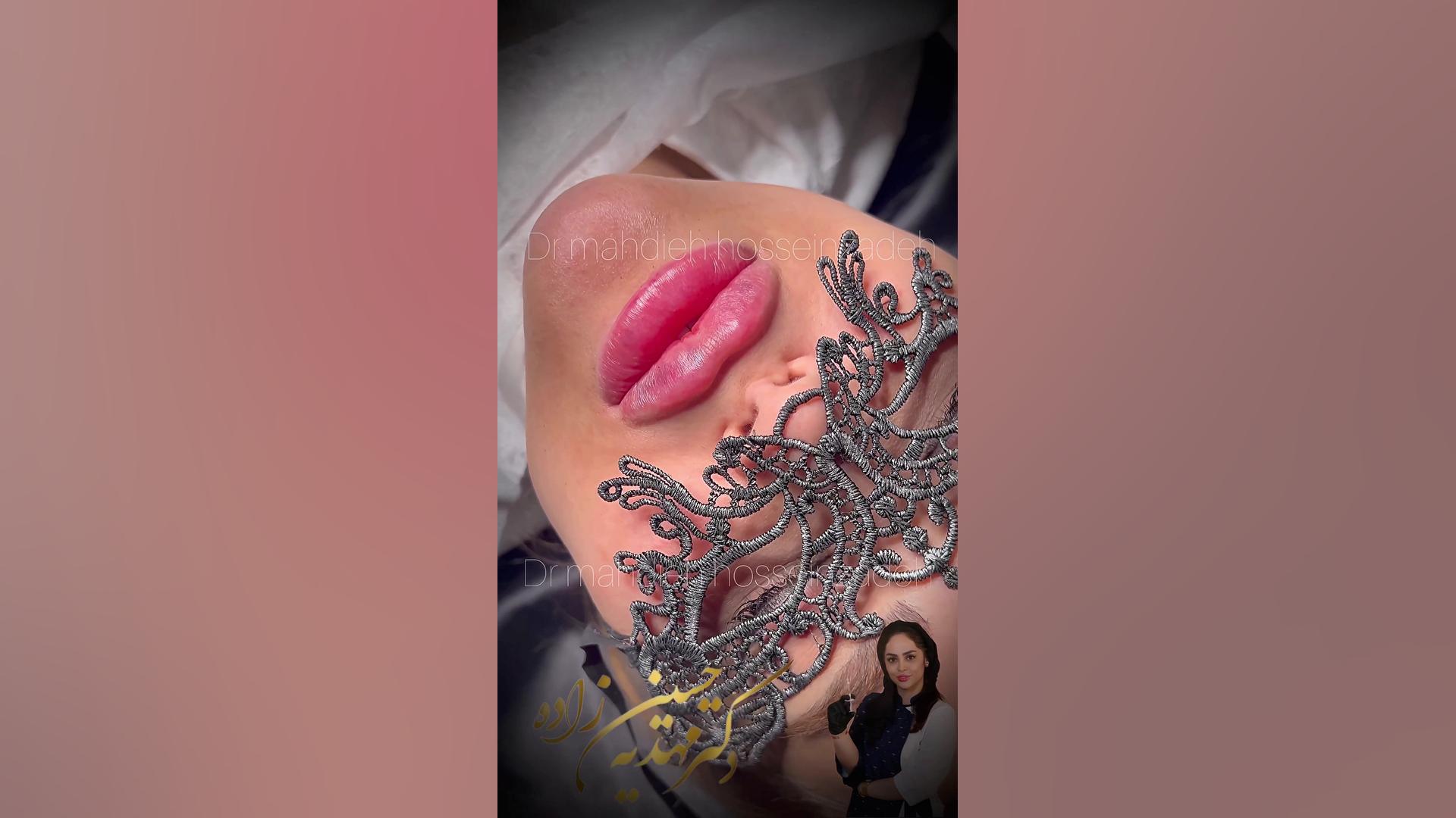 تزریق لب روسی در رشت/کلینیک زیبایی رشت/دکتر مهدیه حسین زاده کلینیک زیبایی رشت دکتر مهدیه حسین زاده