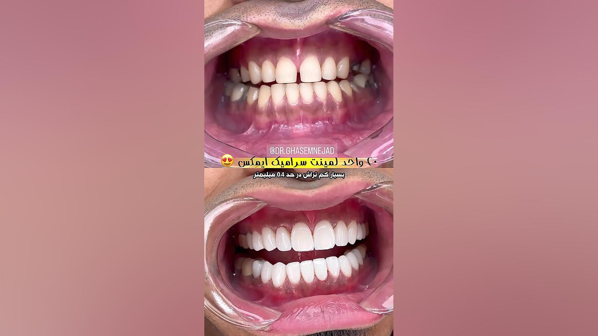لمینت دندان سرامیکی ایمکس دندانپزشکی زیبایی دکتر قاسم نژاد