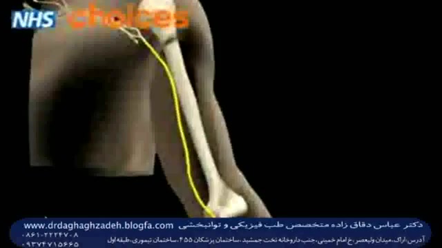 گیرافتادگی وچسبندگی عصب مچ دست(سندرم تونل کارپ یامچ دست) کریستیانو رونالدو