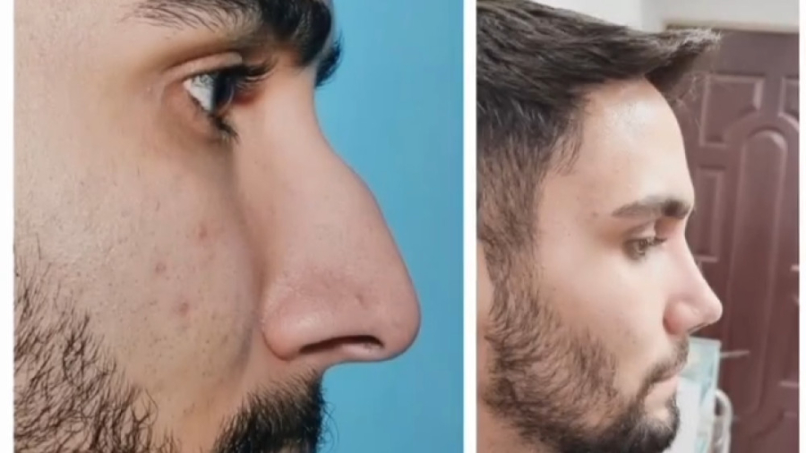جراحی بینی بعد از یک ماه دکتر علی شفیعی رونیزی | بهترین جراح بینی تهران
