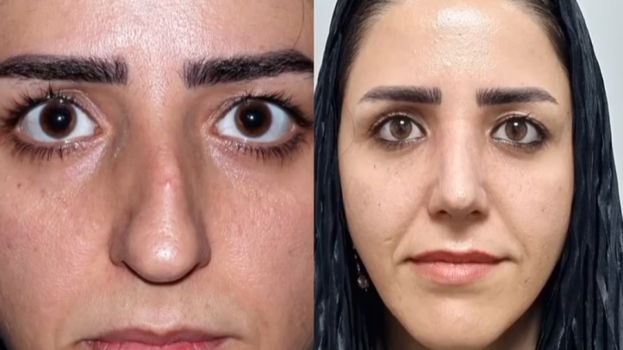جراحی بینی گوشتی دکتر علی شفیعی رونیزی | بهترین جراح بینی تهران