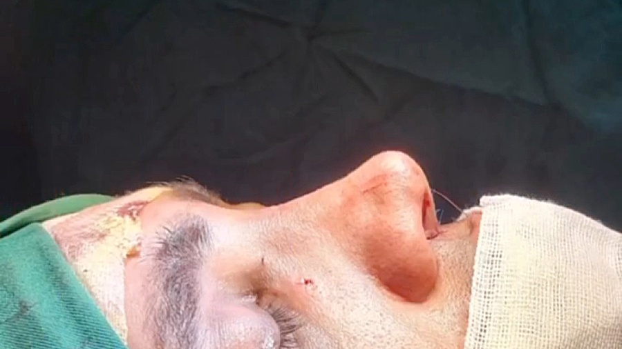 نتیحه یک ماه بعد در بینی گوشتی و با انحراف و کجی و قوز دکتر علی شفیعی رونیزی | بهترین جراح بینی تهران