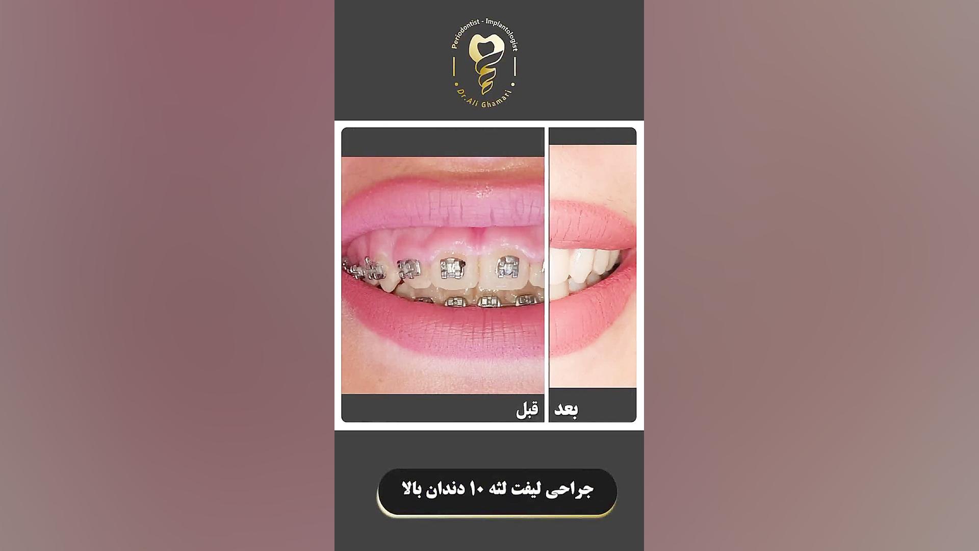 جراحی لیفت لثه ۱۰ دندان بالا دکتر علی قمری - متخصص جراحی لثه و ایمپلنت
