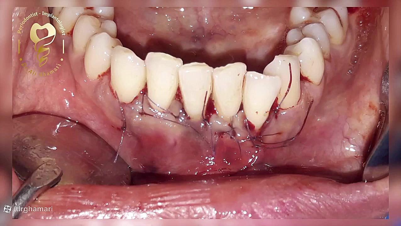 پیوند لثه دندان های جلو فک پایین دکتر علی قمری - متخصص جراحی لثه و ایمپلنت