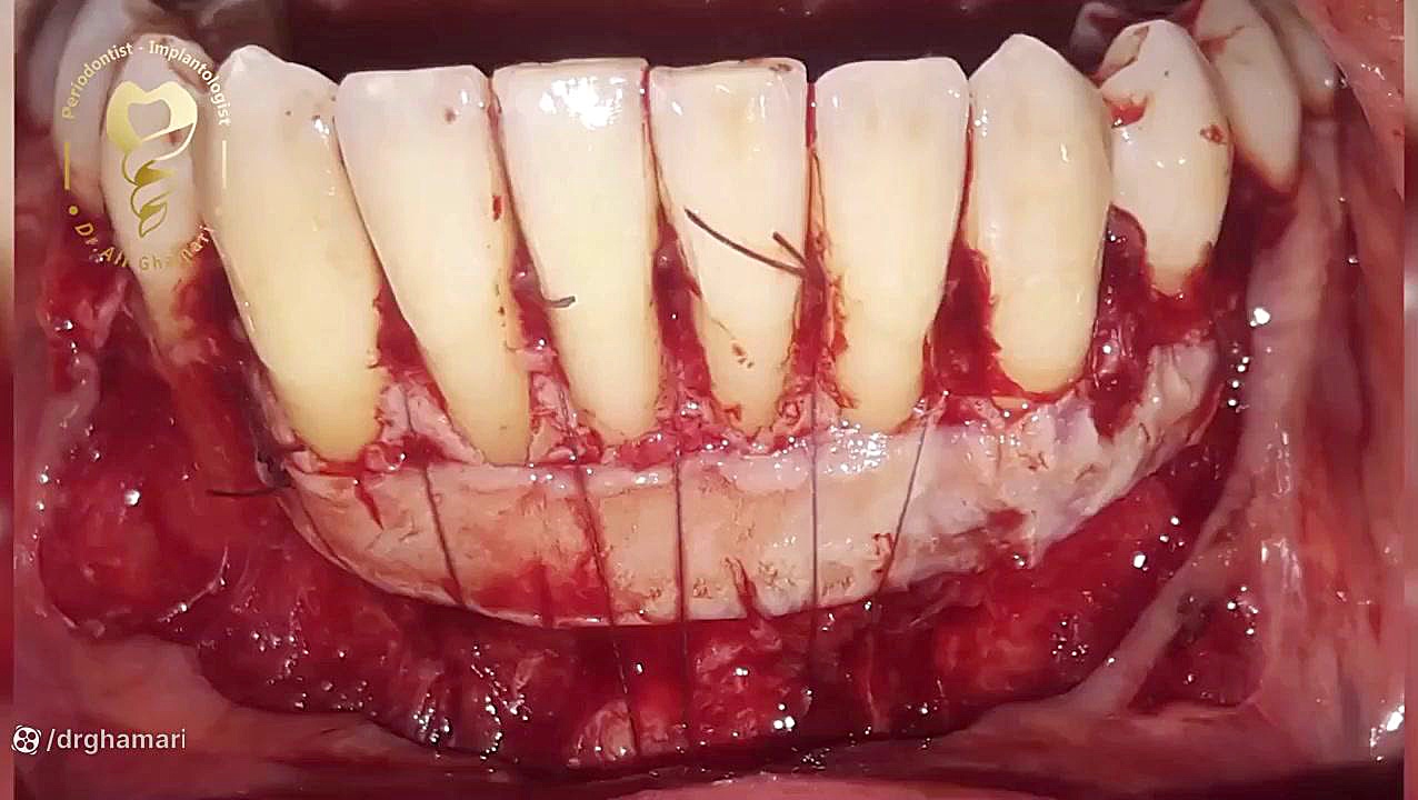جراحی پیوند لثه دکتر علی قمری - متخصص جراحی لثه و ایمپلنت
