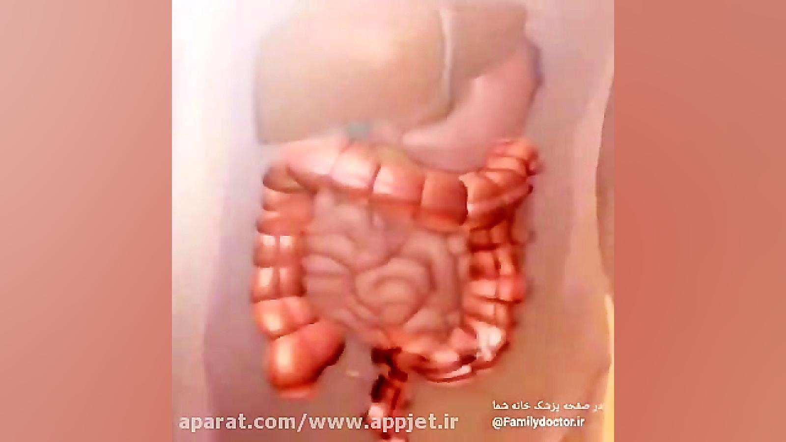 کولونوسکوپی چطور انجام می شود؟ برداشتن خال گوشتی
