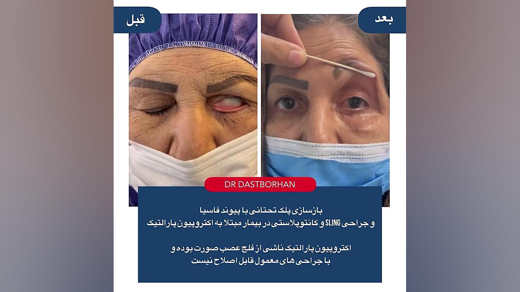جراحی پلاستیک بیماری های پلک تحتانی آتپازیب