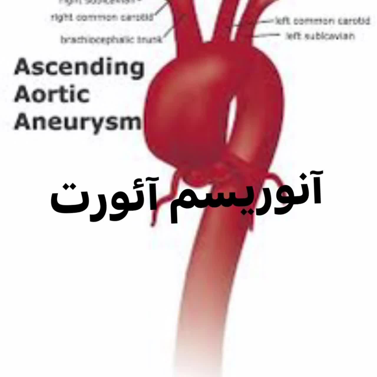 جراحي آنوريسم آئورت صعودي بررسی لک صورت
