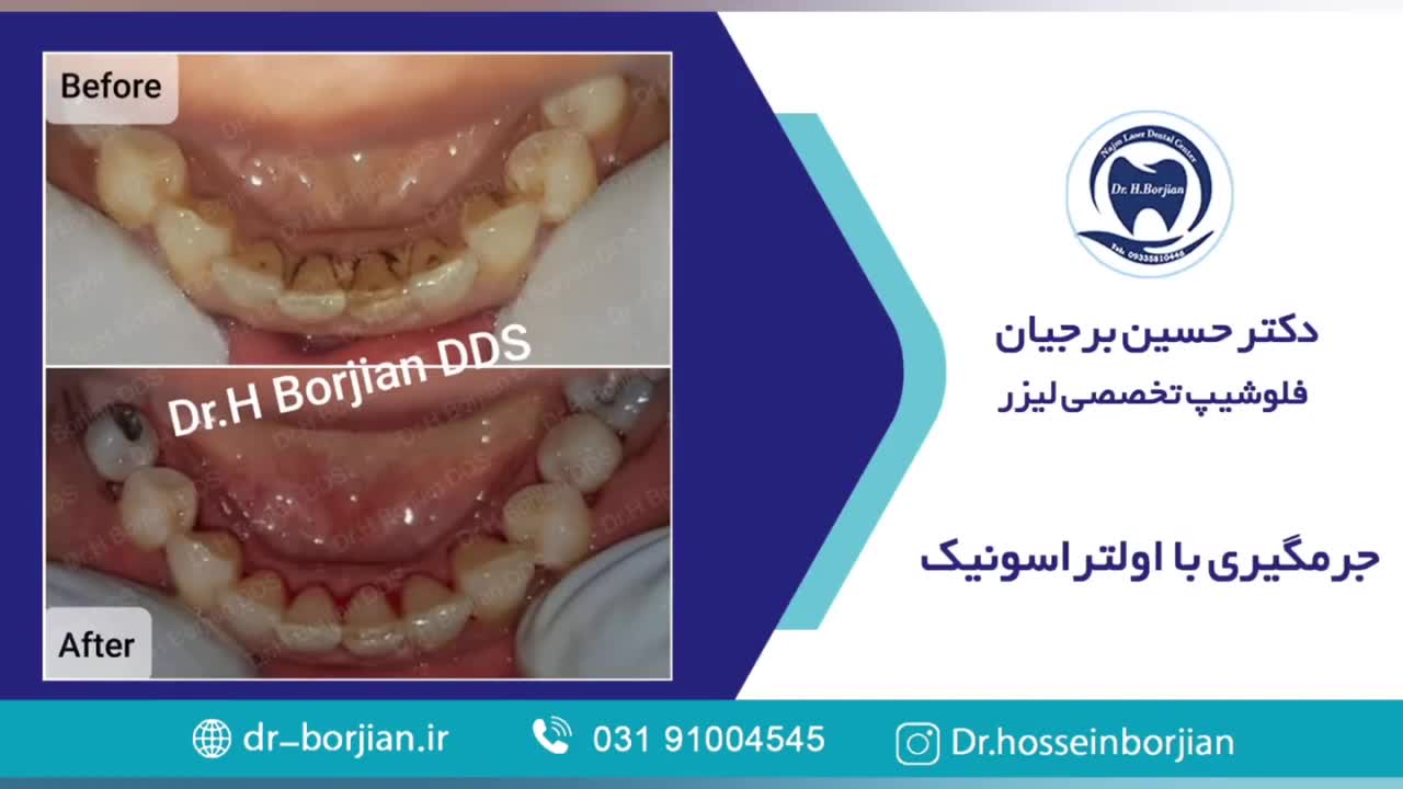 نمونه جرمگیری زیرلثه ای با اولتراسونیک | بهترین دندانپزشک زیبایی اصفهان ان트ريكتینیب