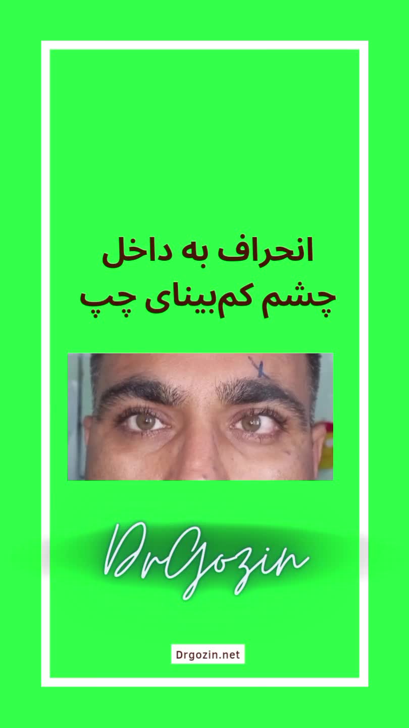 بهترین فوق تخصص استرابیسم دکتر گزین، جراحی انحراف چشم بدون بیهوشی لمینت